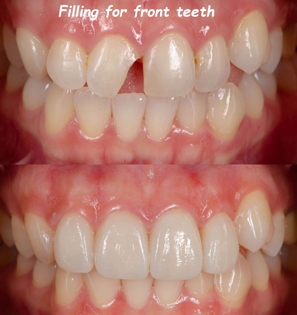 Filling for front teeth