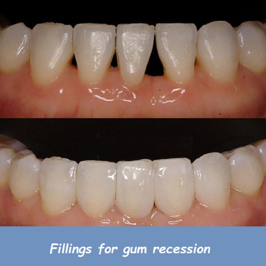 Fillings for gum recession