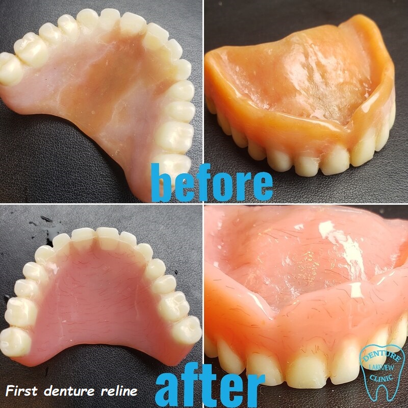 First denture reline