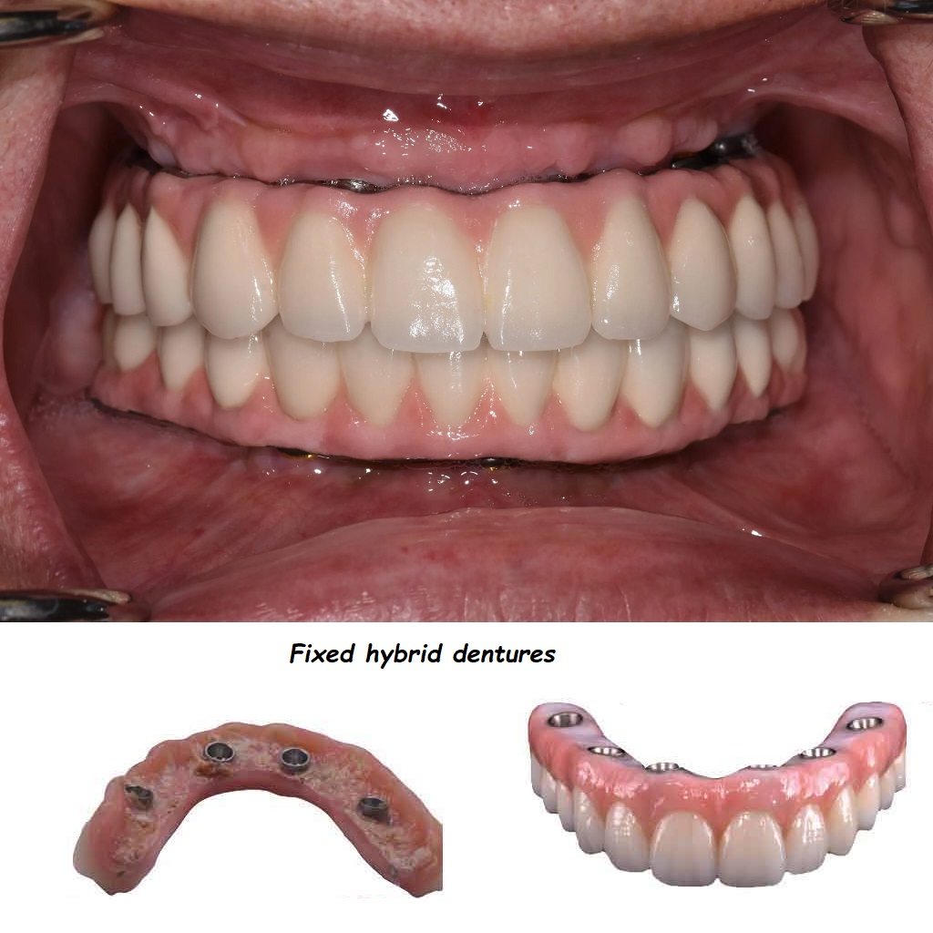 Fixed hybrid dentures