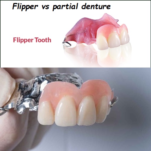 Flipper vs partial denture