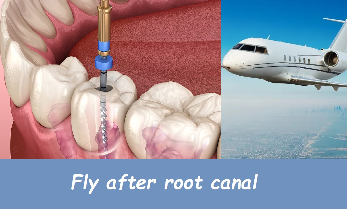 Fly after root canal