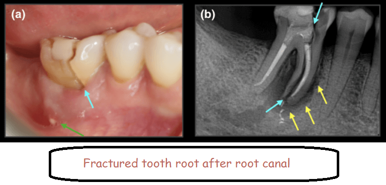 Fractured tooth root after root canal