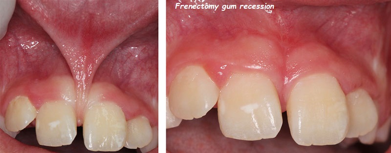 Frenectomy gum recession