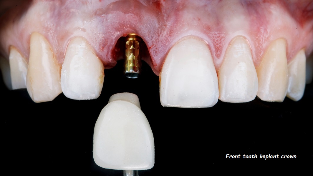 front tooth implant crown