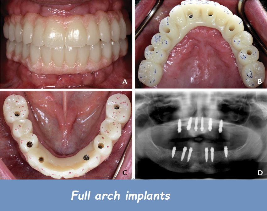 Full arch implants