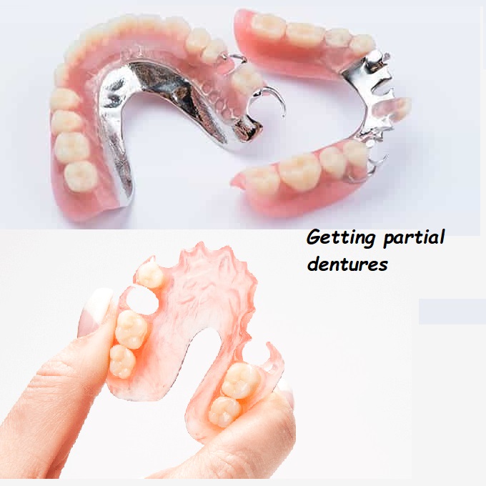 Getting partial dentures