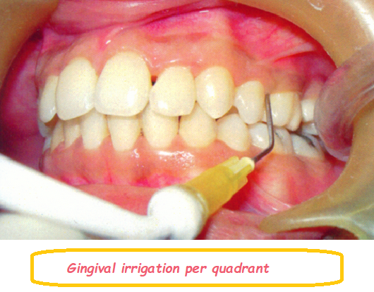 Gingival irrigation per quadrant