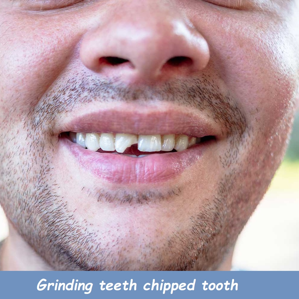 grinding teeth chipped tooth