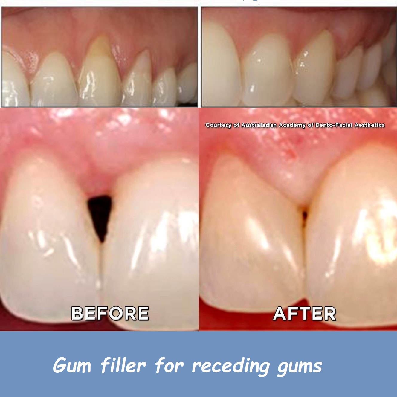 Gum filler for receding gums