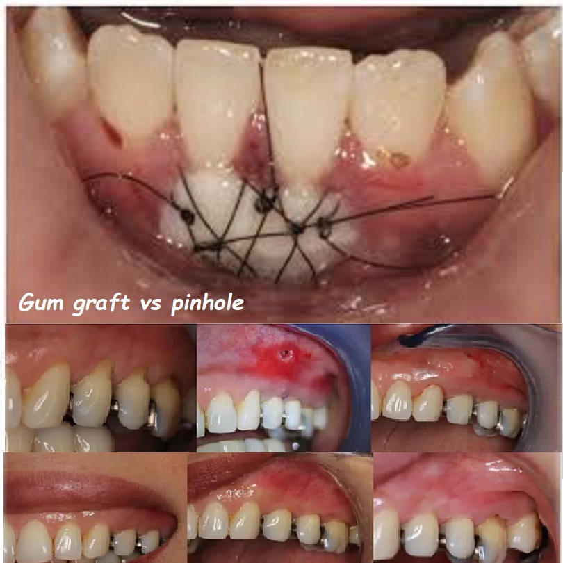 Gum graft vs pinhole