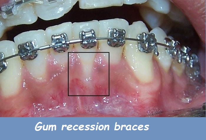 Gum recession braces