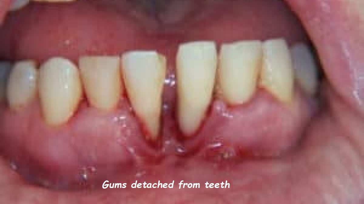 Gums detached from teeth