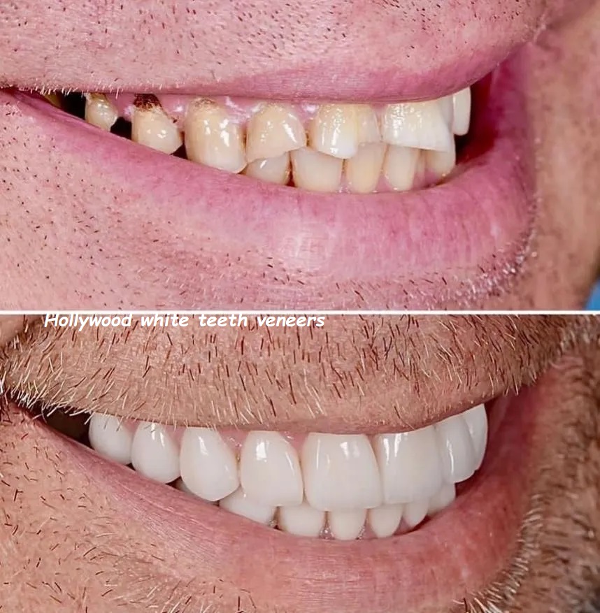 hollywood white teeth veneers