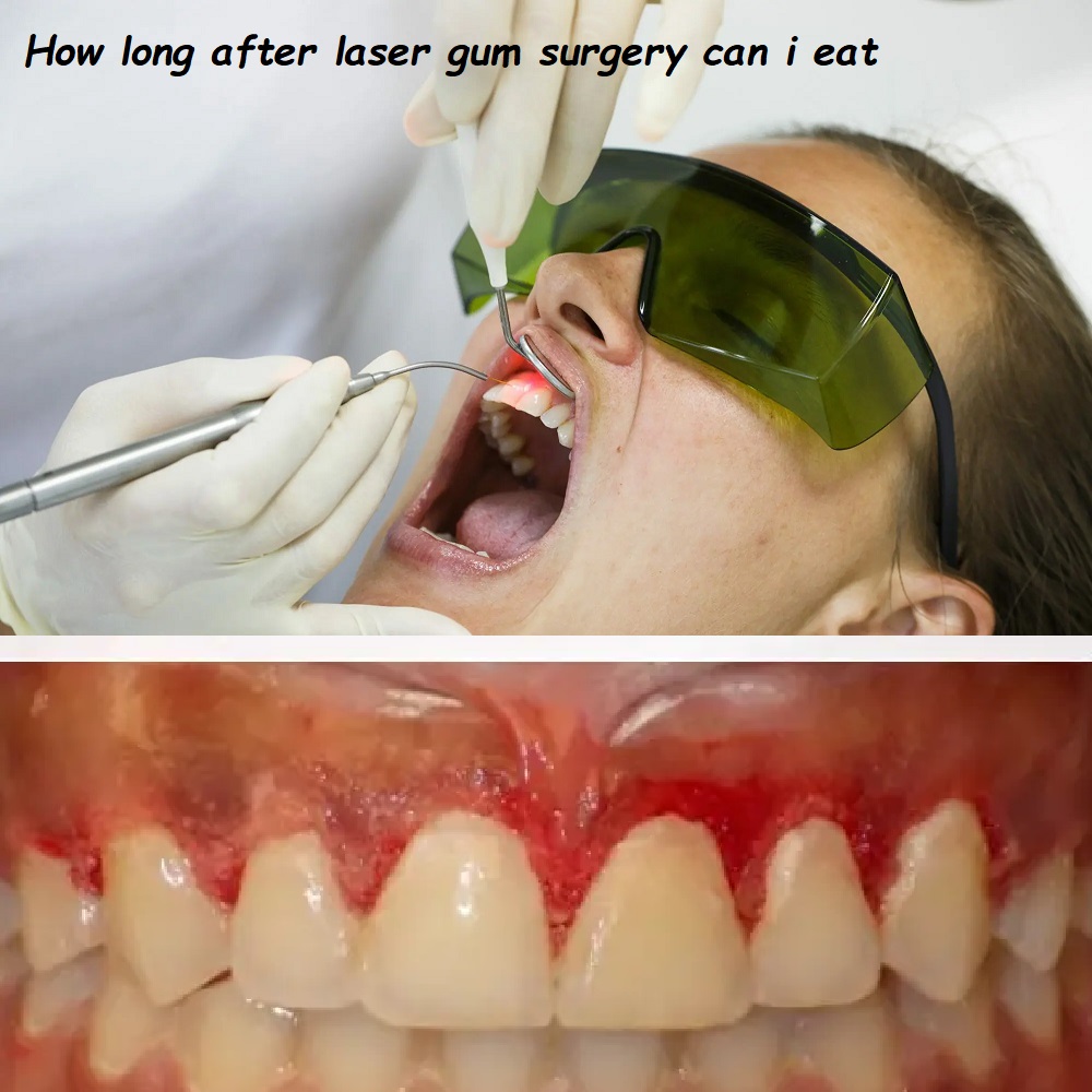 How long after laser gum surgery can i eat