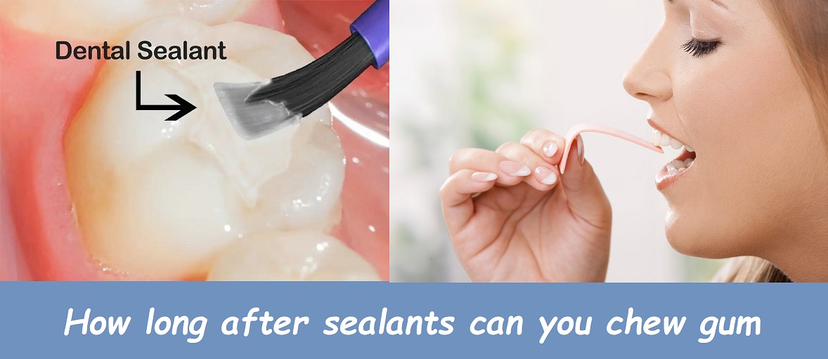 How long after sealants can you chew gum