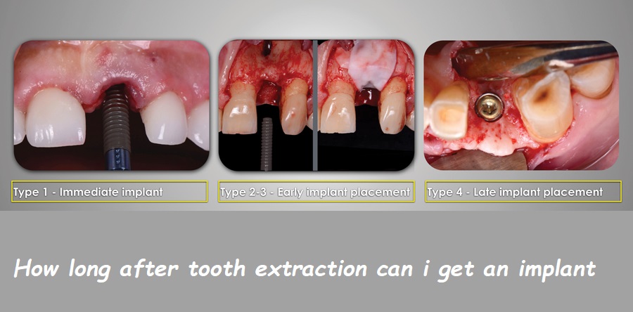 how long after tooth extraction can i get an implant