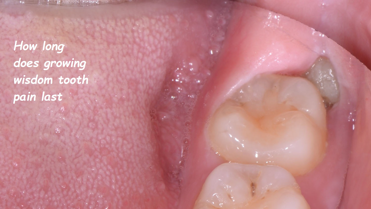 how long does growing wisdom tooth pain last