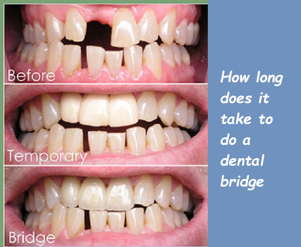 how long does it take to do a dental bridge