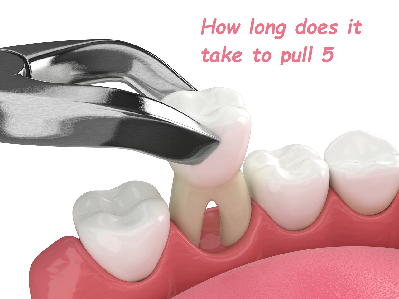 How long does it take to pull 5 teeth