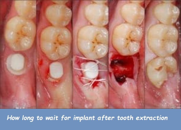 how long to wait for implant after tooth extraction