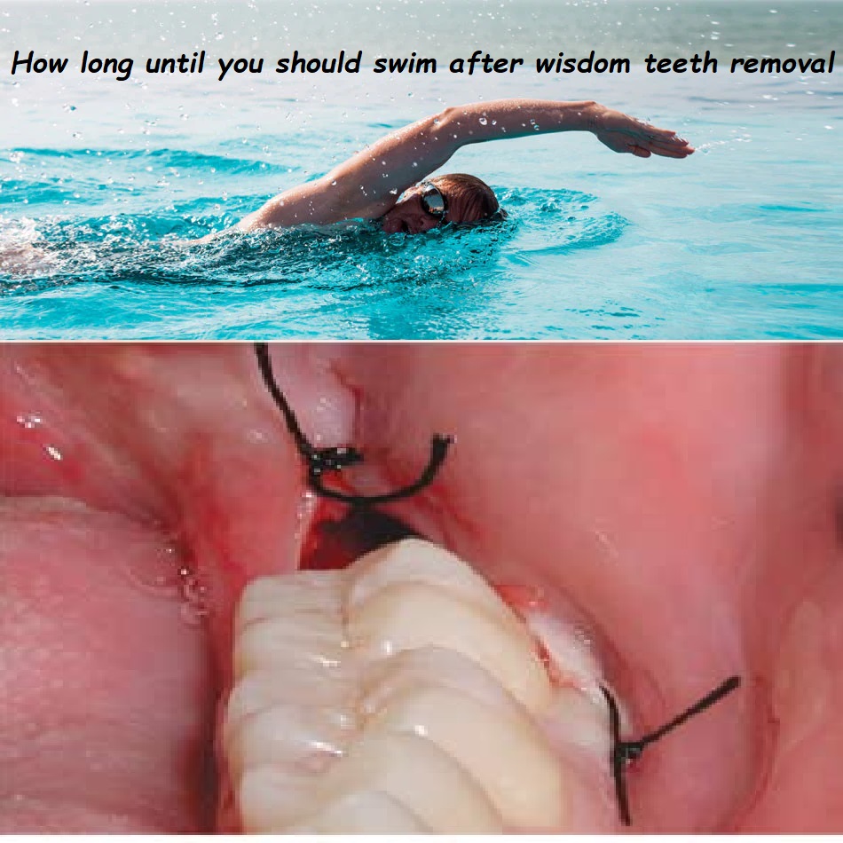 How long until you should swim after wisdom teeth removal