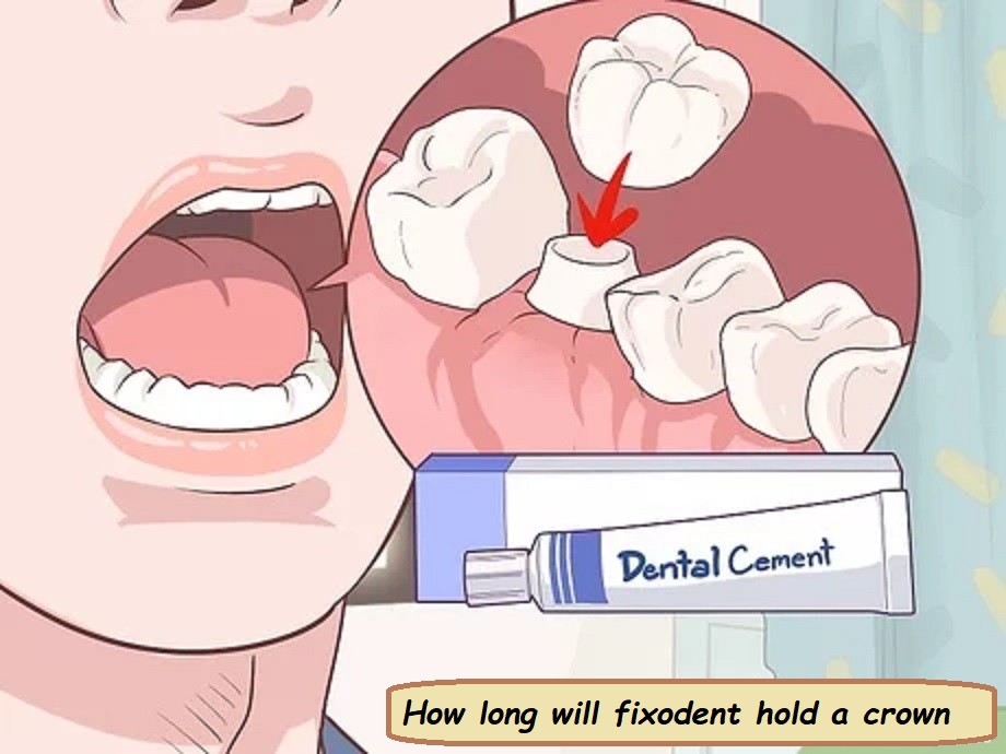 How long will fixodent hold a crown