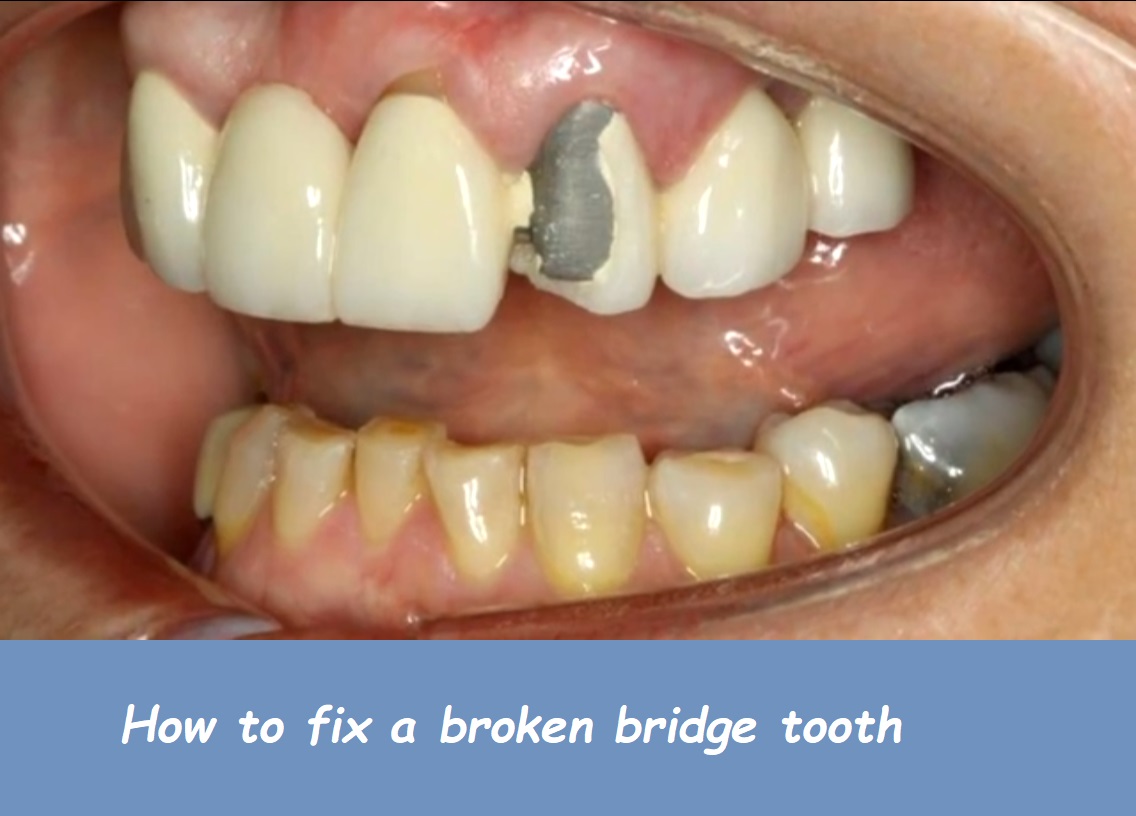 how to fix a broken bridge tooth