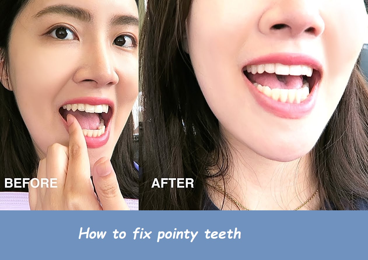 How to fix pointy teeth