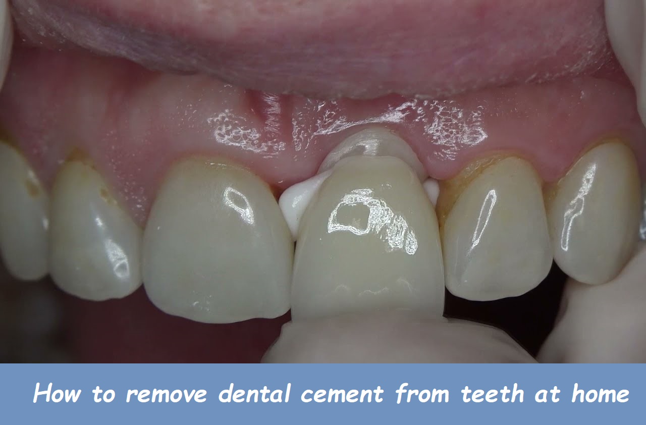 How to remove dental cement from teeth at home