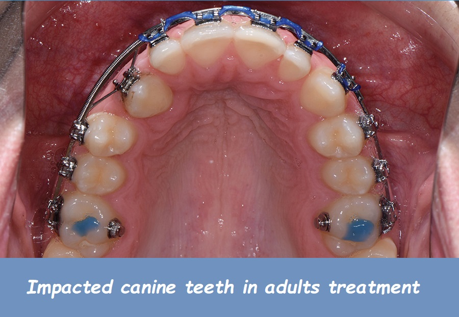 impacted canine teeth in adults treatment