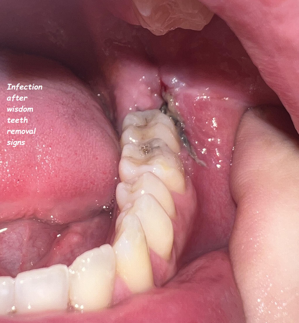 Infection after wisdom teeth removal signs