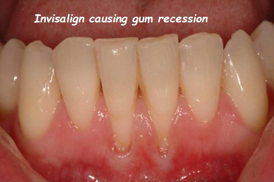 Invisalign causing gum recession