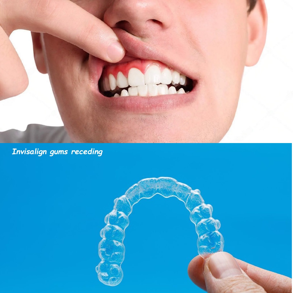 Invisalign gums receding