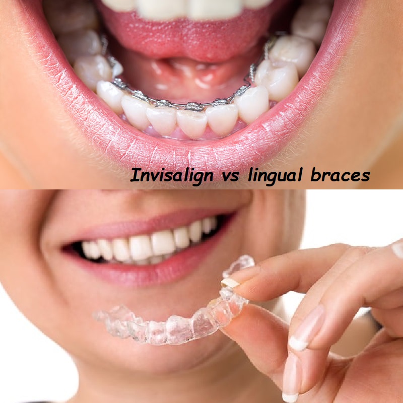 Invisalign vs lingual braces