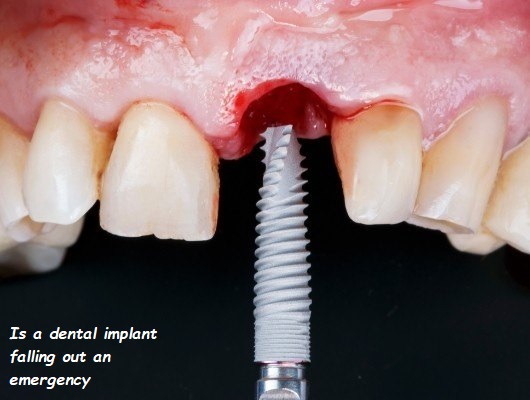 is a dental implant falling out an emergency