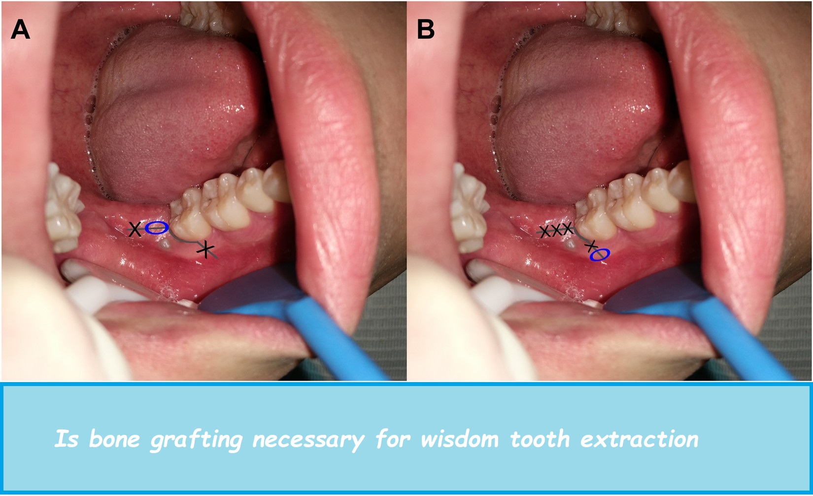 Is bone grafting necessary for wisdom tooth extraction