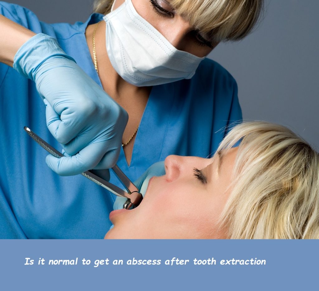 is it normal to get an abscess after tooth extraction