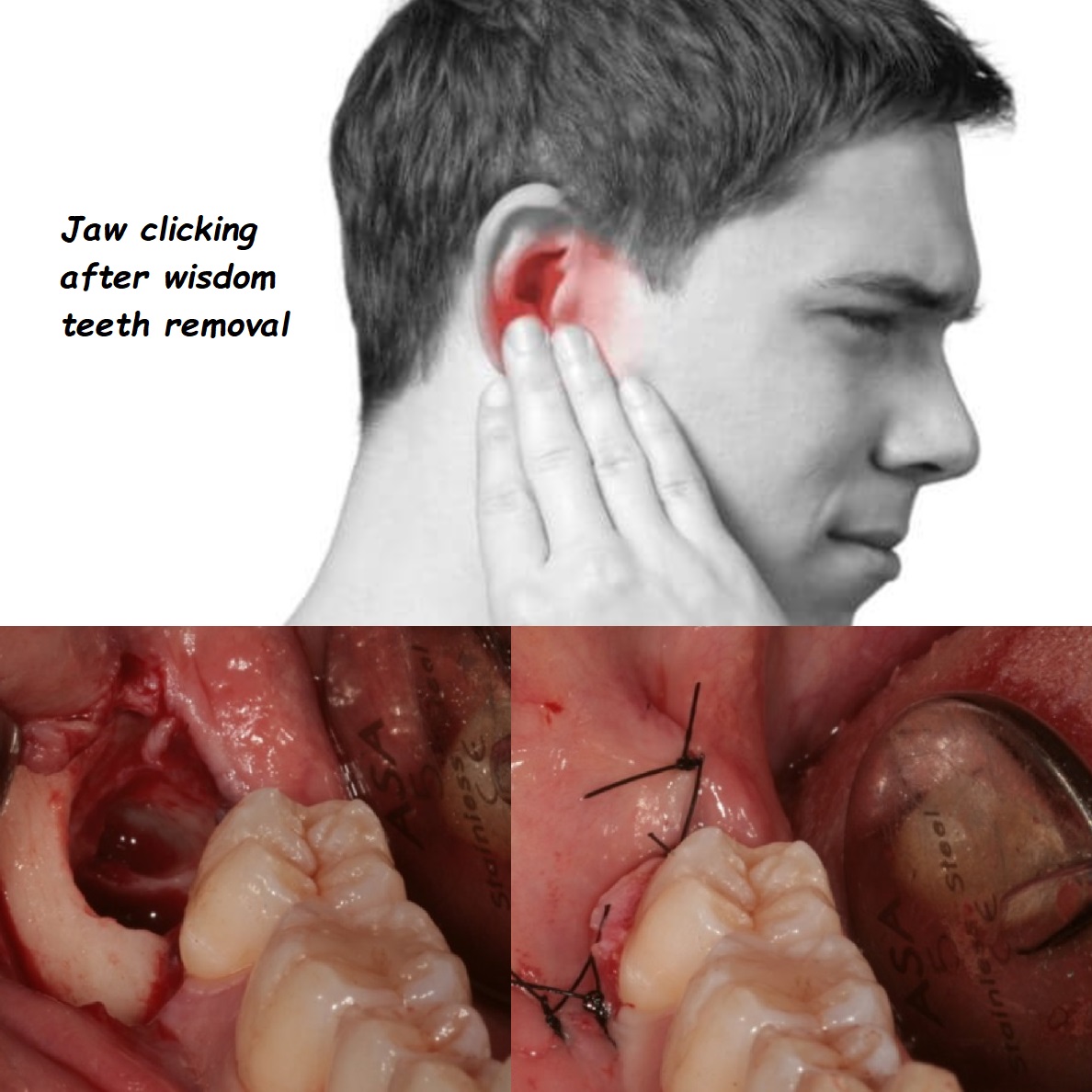 Jaw clicking after wisdom teeth removal