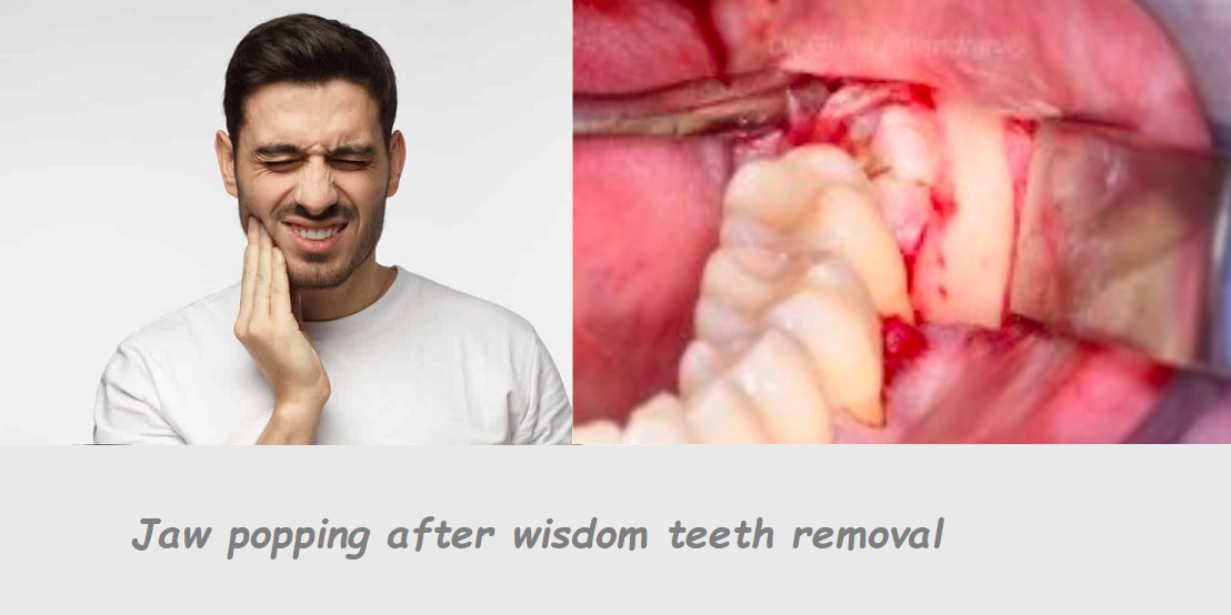 Jaw popping after wisdom teeth removal