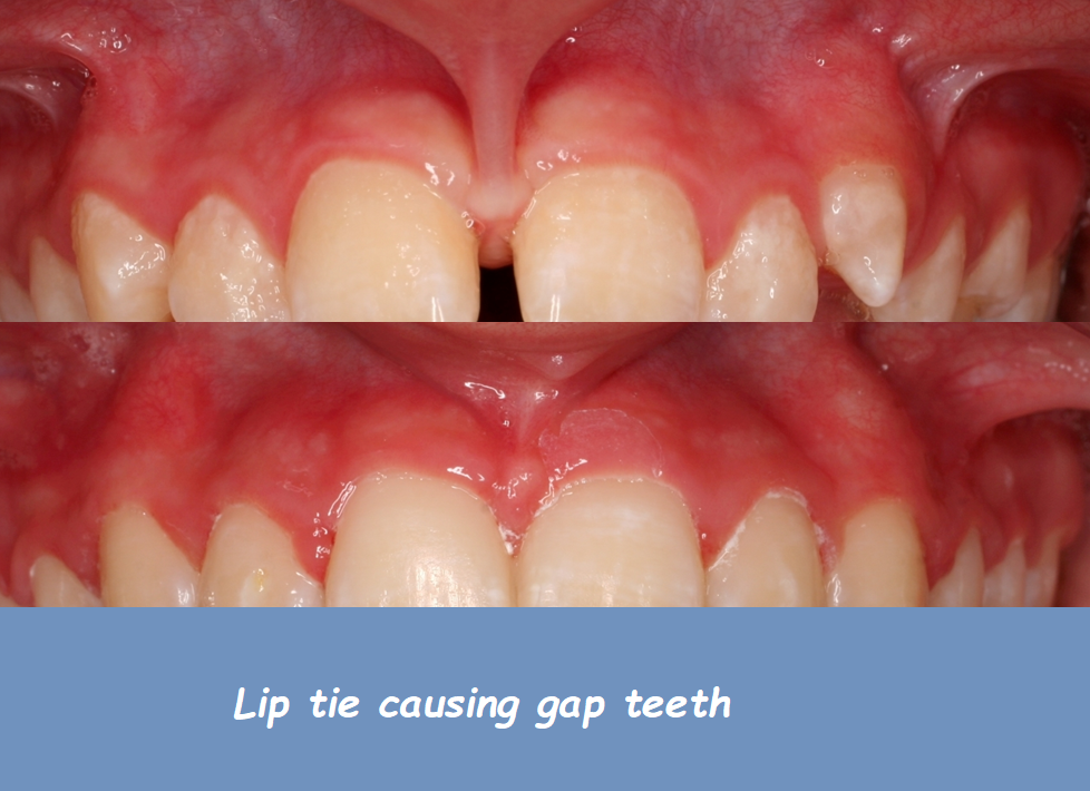 Lip tie causing gap teeth