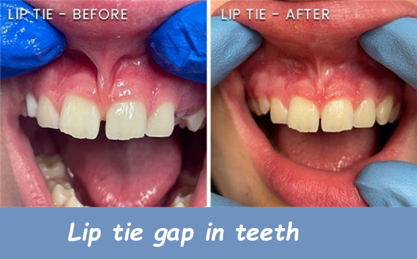 lip tie gap in teeth