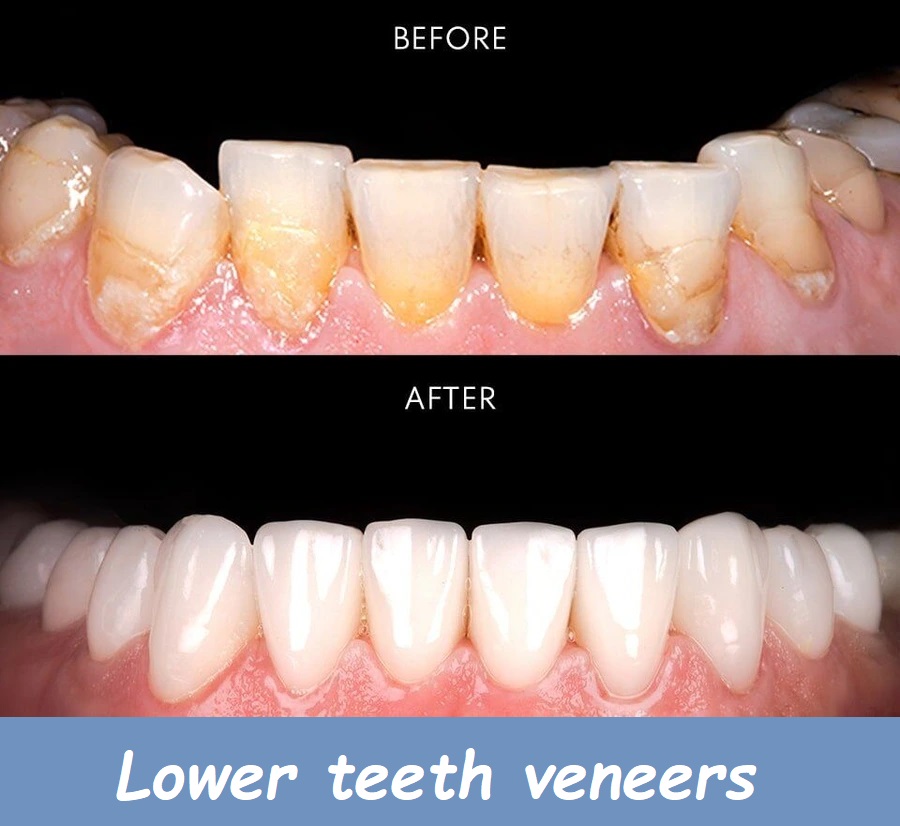 Lower teeth veneers