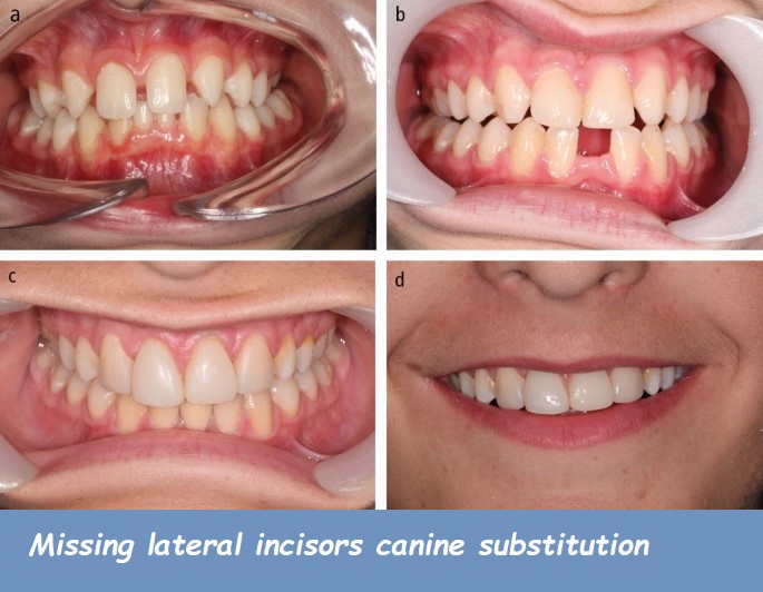 Missing lateral incisors canine substitution