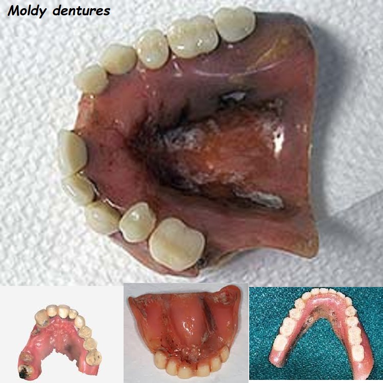 Moldy dentures