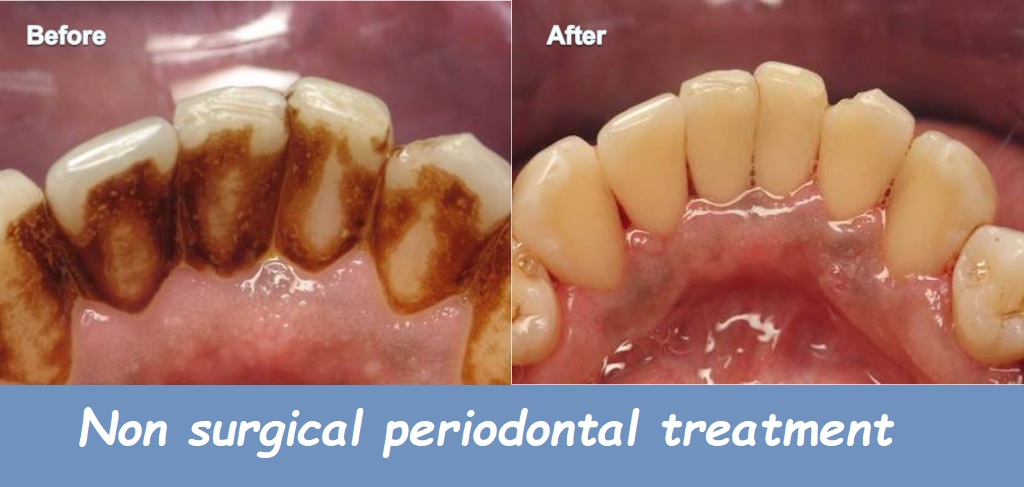 Non surgical periodontal treatment