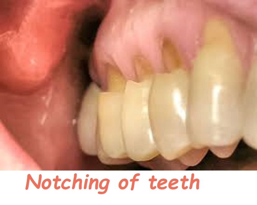 Notching of teeth