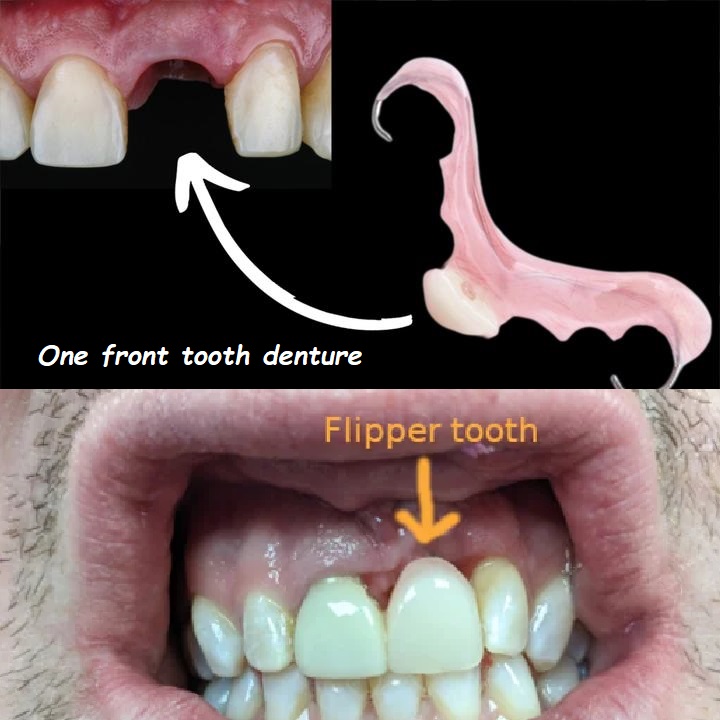 One front tooth denture