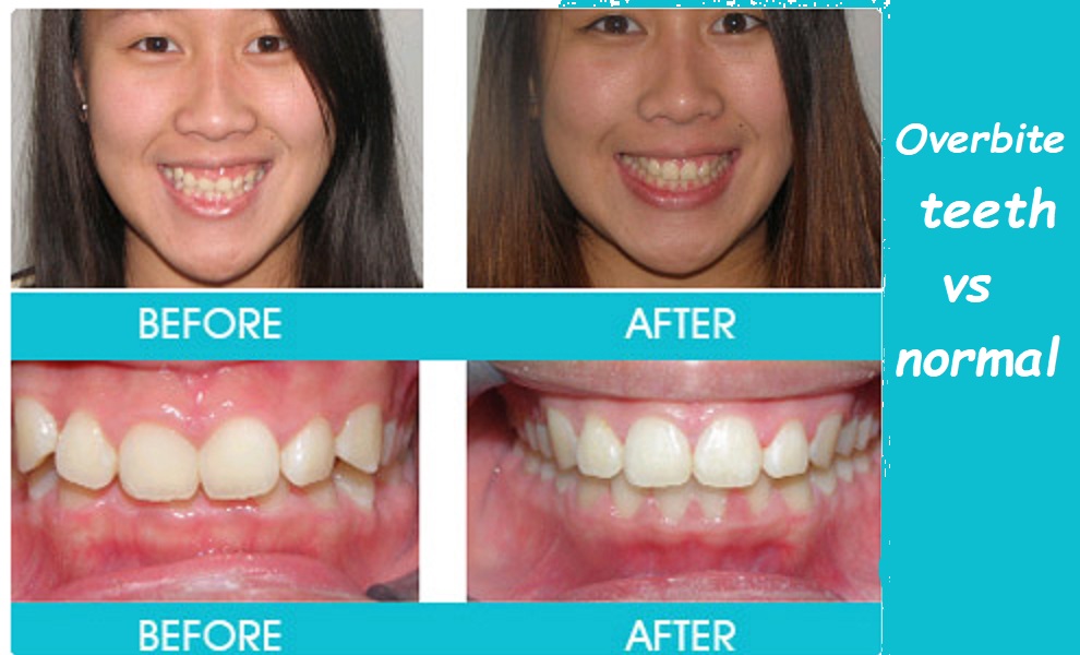 Overbite teeth vs normal