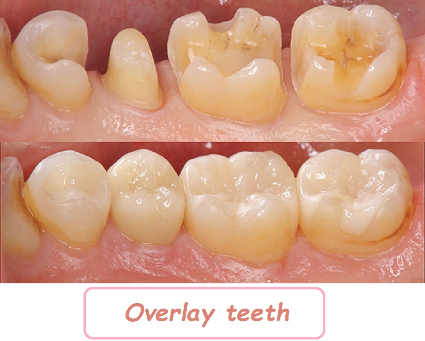 Overlay teeth